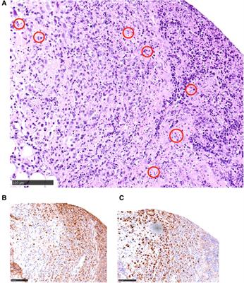 Case Report: Multiple autoimmune syndrome (MAS)—An unusual combination